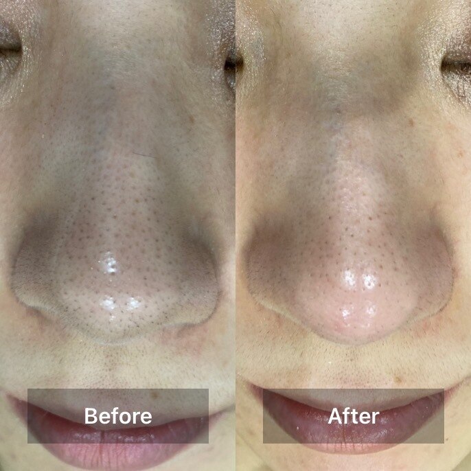 毛穴黒ずみケアのBefore/After