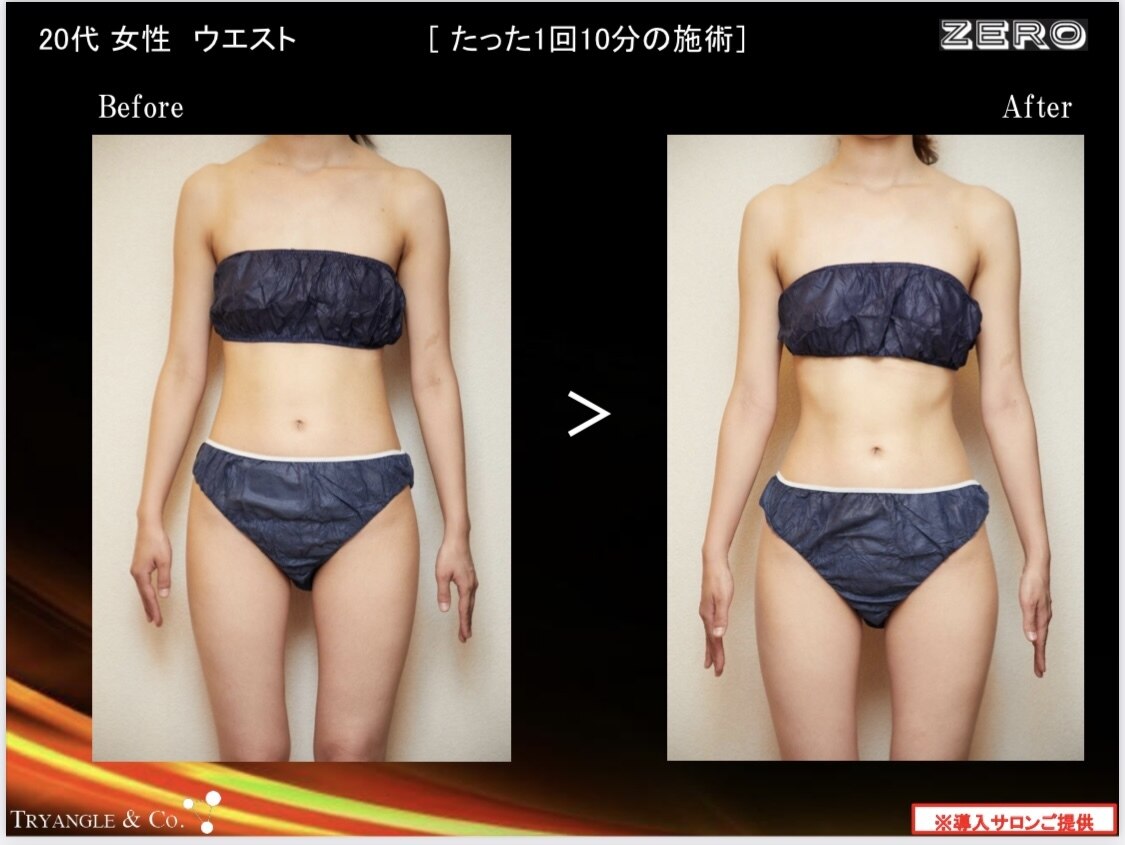 痩身キャビゼロのBefore/After